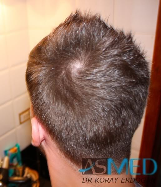 Before and After  graft    transplant at 