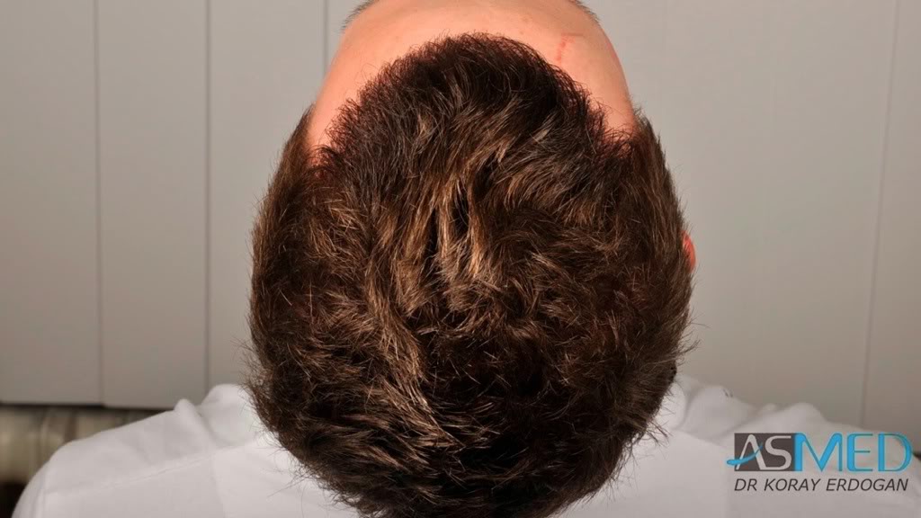 Before and After  graft    transplant at 