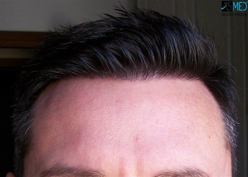 Before and After  graft    transplant at 