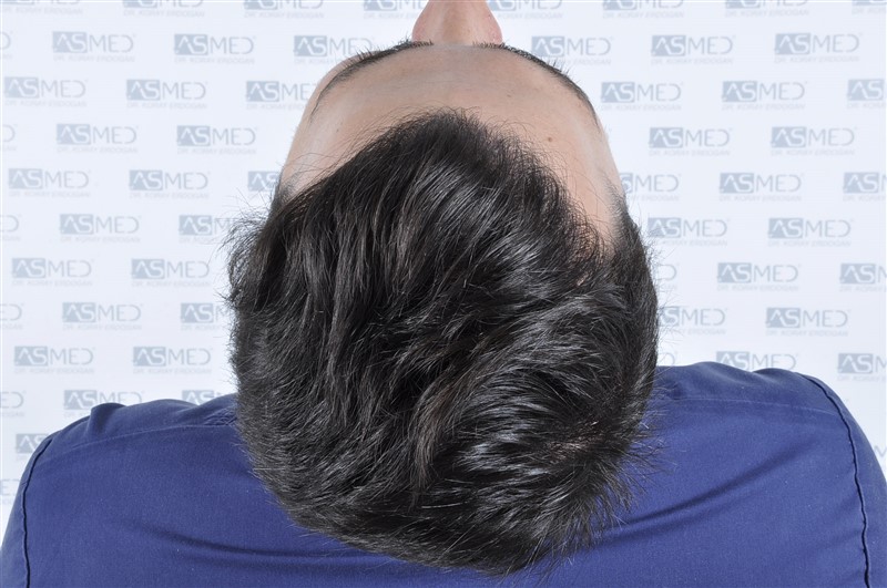 Before and After  graft    transplant at 