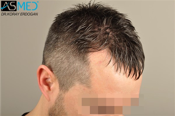 Before and After  graft    transplant at 