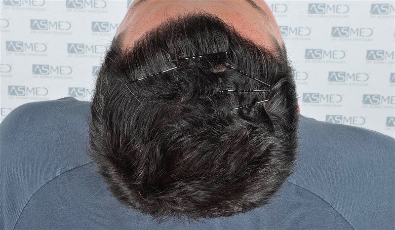 Before and After  graft    transplant at 