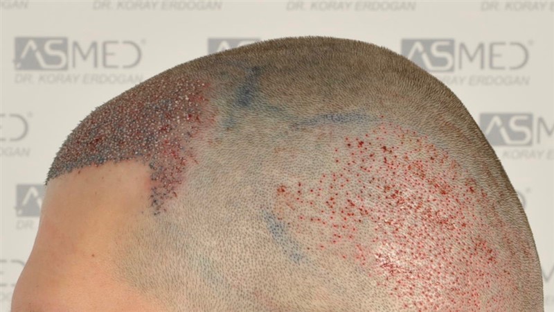 Before and After  graft    transplant at 