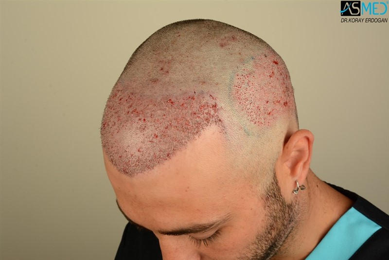 Before and After  graft    transplant at 