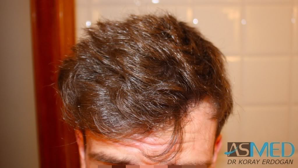 Before and After 1950 graft  FUE hair transplant at ASMED Medical Center