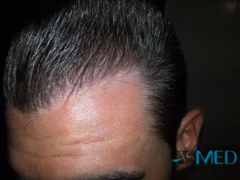 Before and After  graft    transplant at 