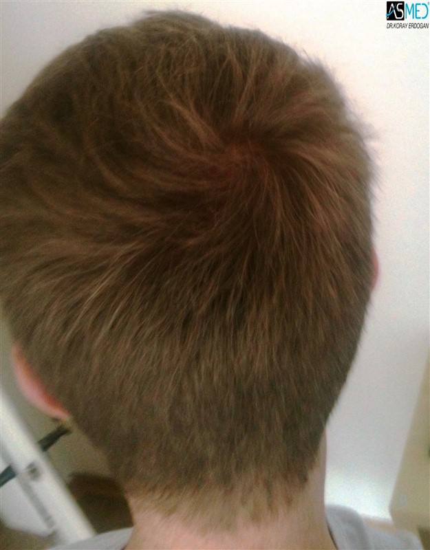 Before and After  graft    transplant at 