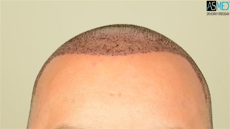 Before and After  graft    transplant at 