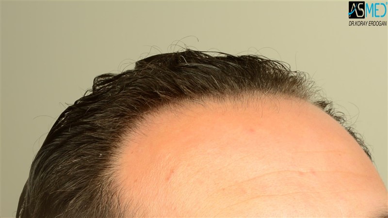 Before and After  graft    transplant at 