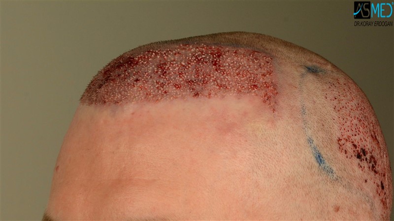 Before and After  graft    transplant at 