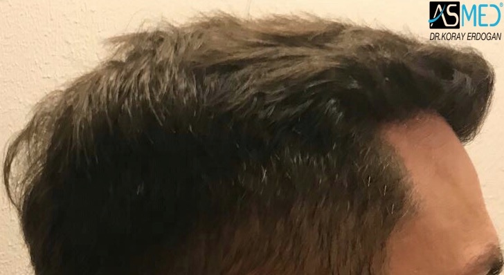 FUE Hair Transplant Result