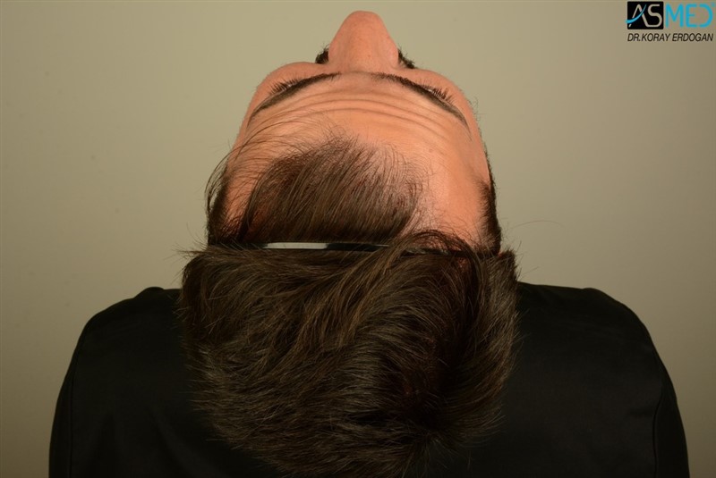 Before and After  graft    transplant at 