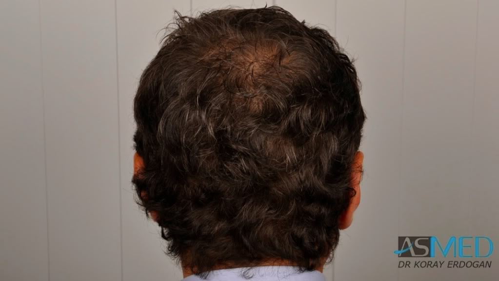 FUE Hair Transplant Result