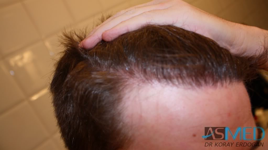 Before and After  graft    transplant at 