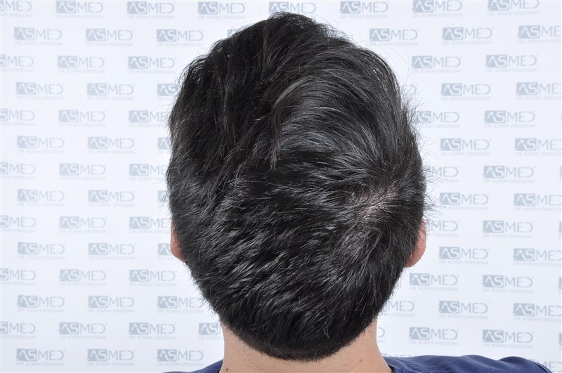 Before and After  graft    transplant at 