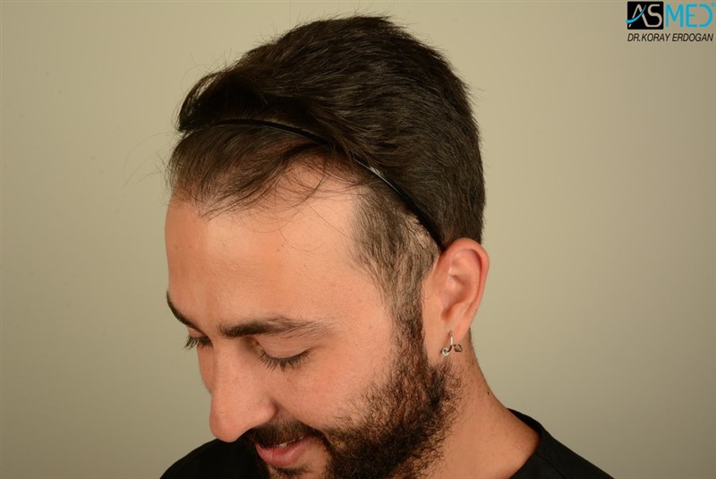 Before and After  graft    transplant at 