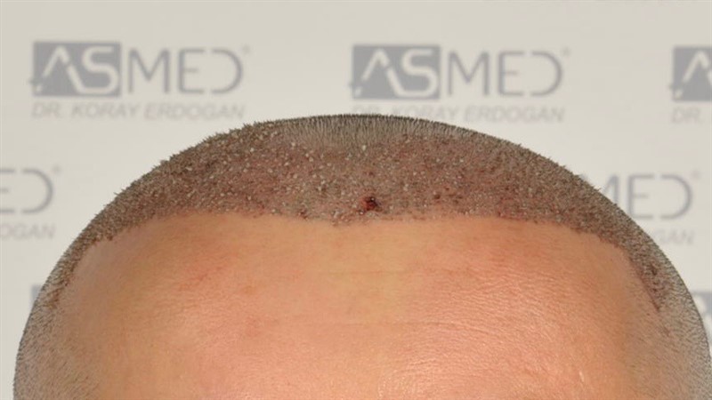 Before and After  graft    transplant at 