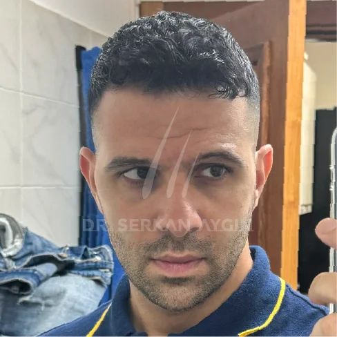 DHI Hair Transplant Result