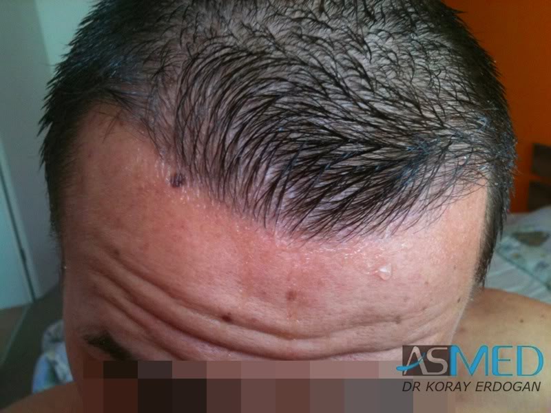 Before and After 1500 graft  FUE hair transplant at ASMED Medical Center
