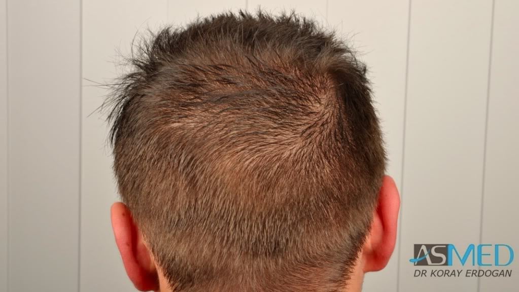 Before and After  graft    transplant at 