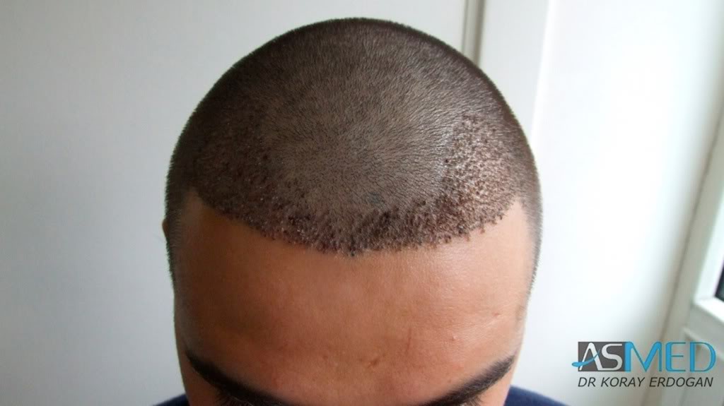 Before and After  graft    transplant at 