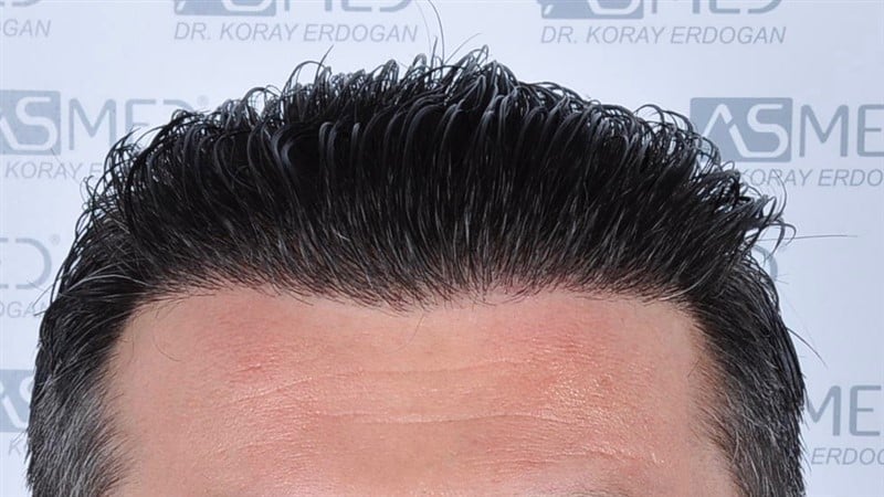 Before and After  graft    transplant at 