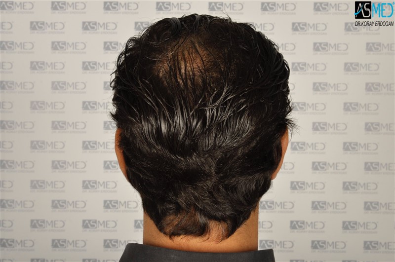 Before and After  graft    transplant at 
