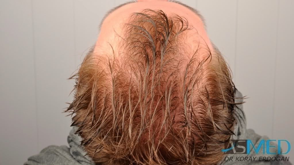 Before and After  graft    transplant at 