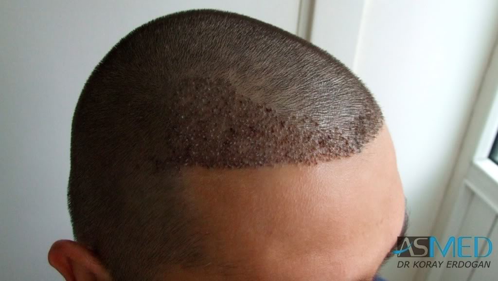 Before and After  graft    transplant at 