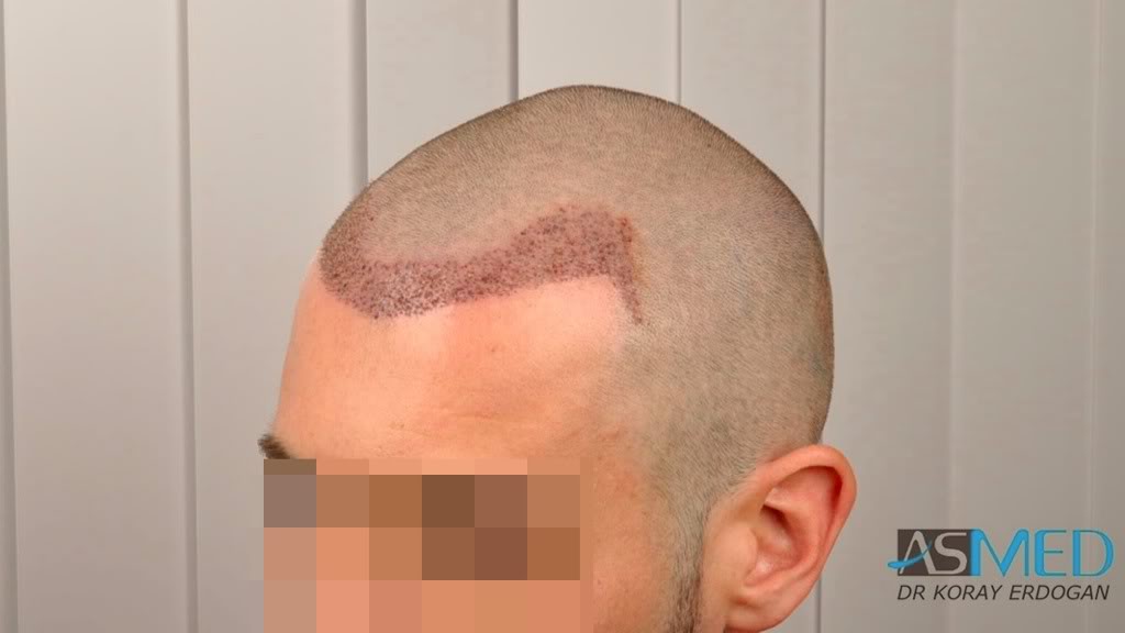 Before and After  graft    transplant at 