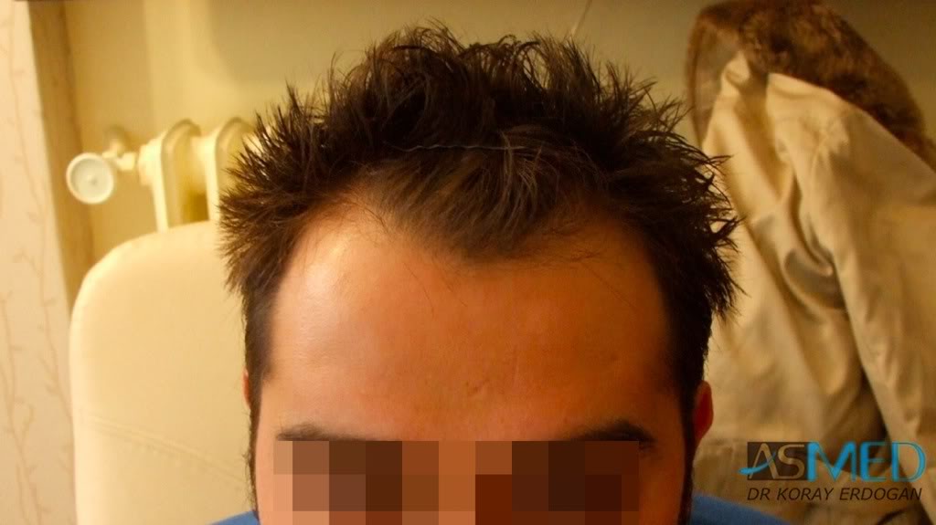 Before and After  graft    transplant at 