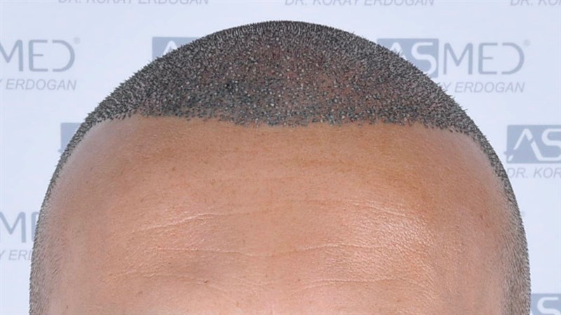 Before and After  graft    transplant at 