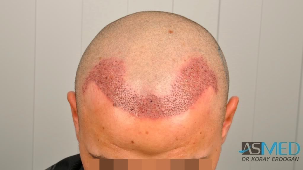 Before and After  graft    transplant at 