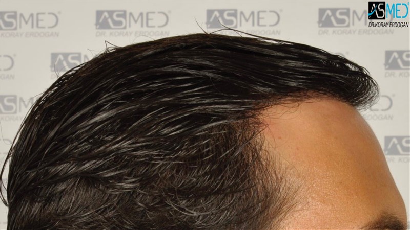 Before and After  graft    transplant at 