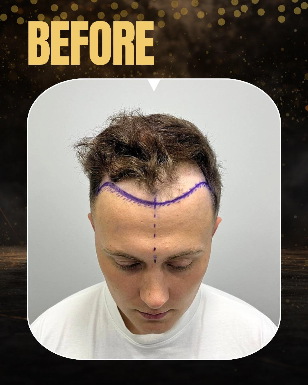 Before and After  graft    transplant at 