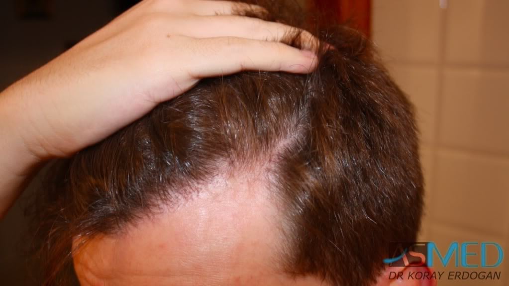 Before and After  graft    transplant at 