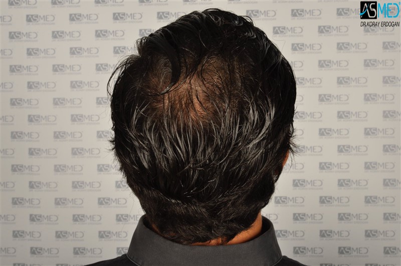 Before and After  graft    transplant at 
