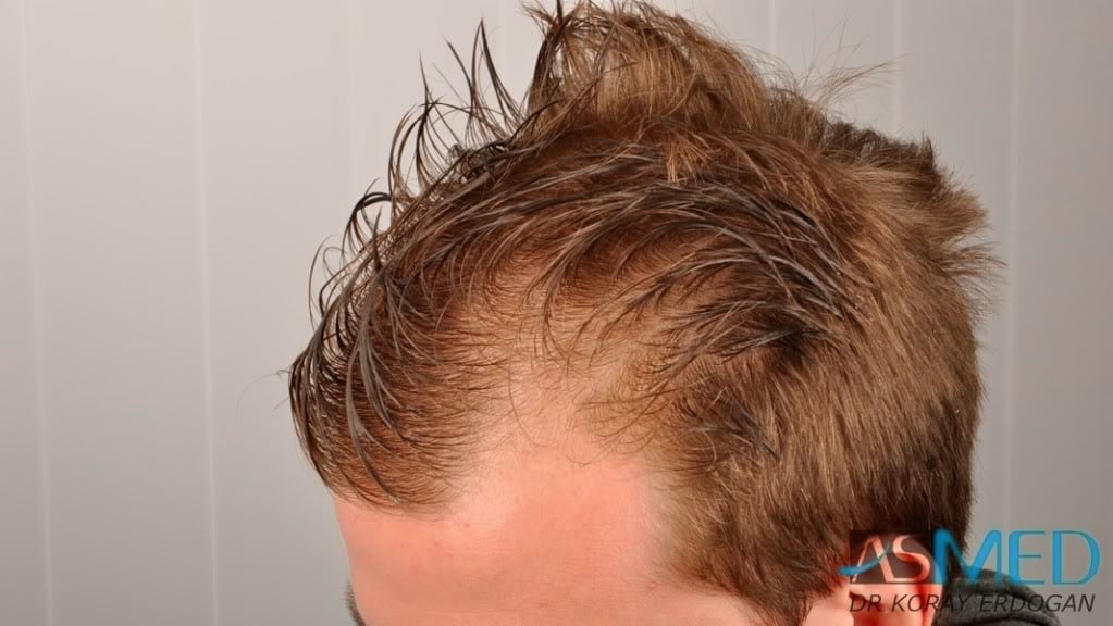 Before and After  graft    transplant at 