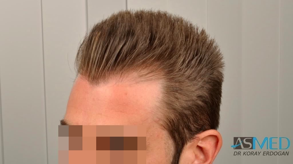 Before and After  graft    transplant at 