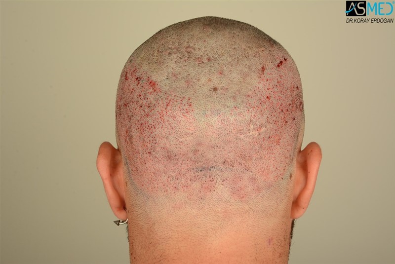 Before and After  graft    transplant at 