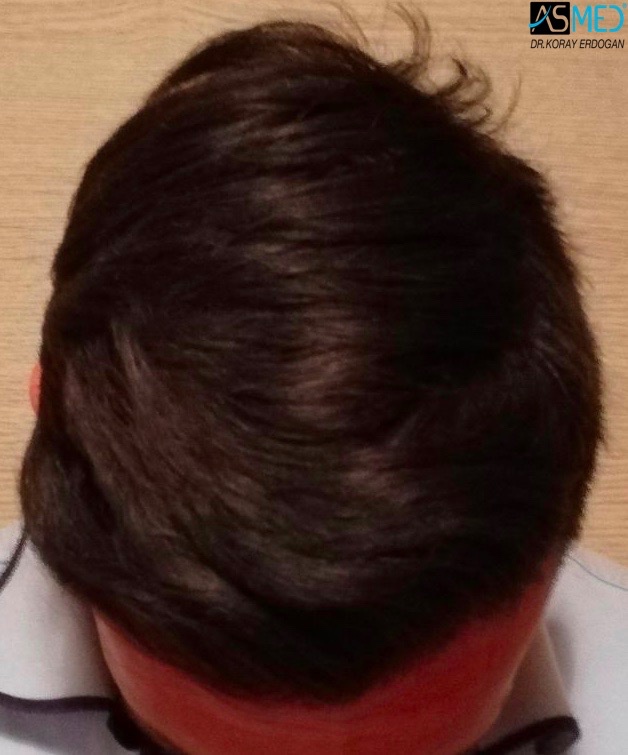Before and After  graft    transplant at 