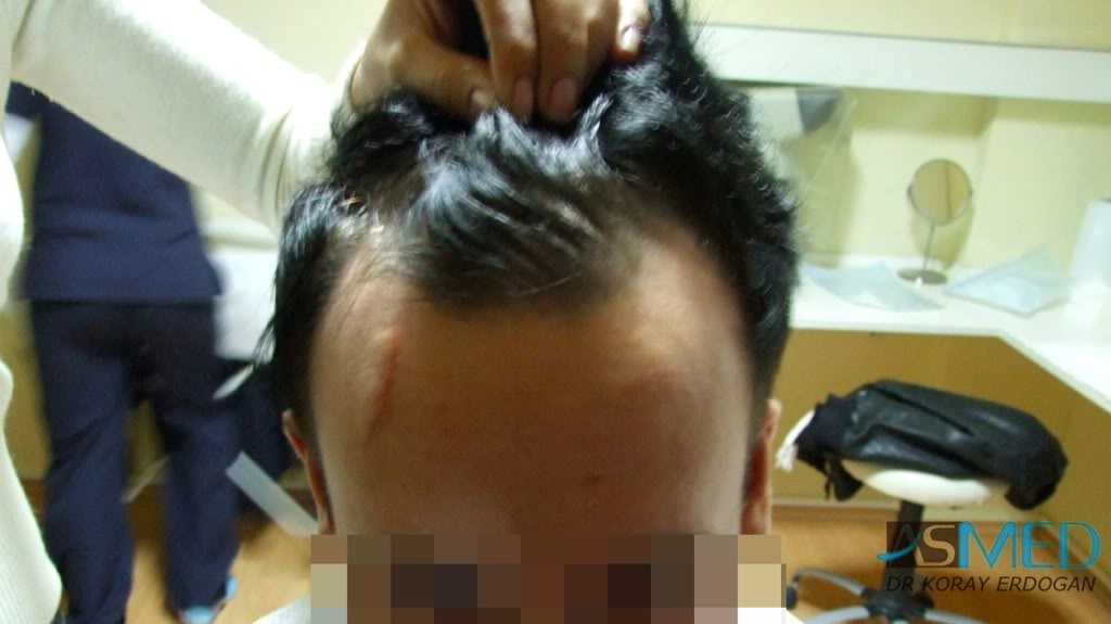 Before and After  graft    transplant at 