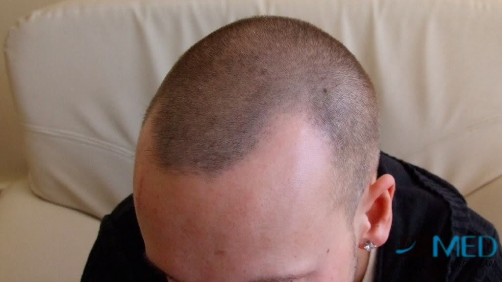 Before and After  graft    transplant at 