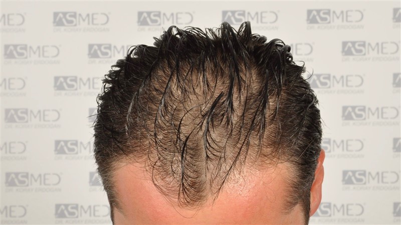 Before and After  graft    transplant at 