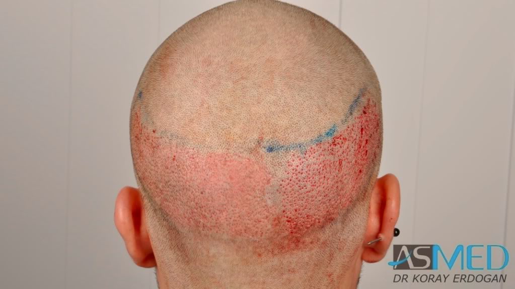 Before and After  graft    transplant at 