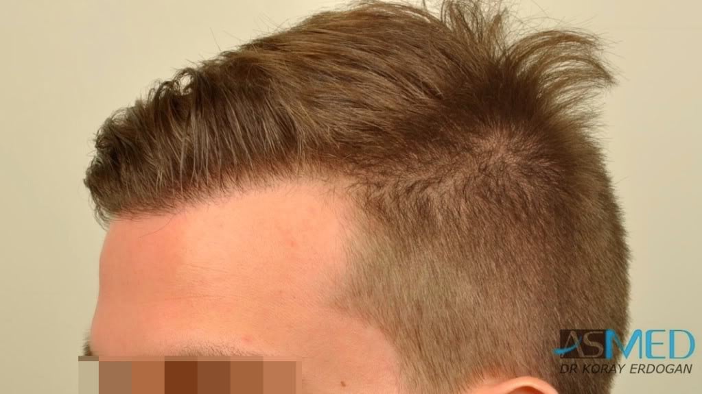 Before and After  graft    transplant at 