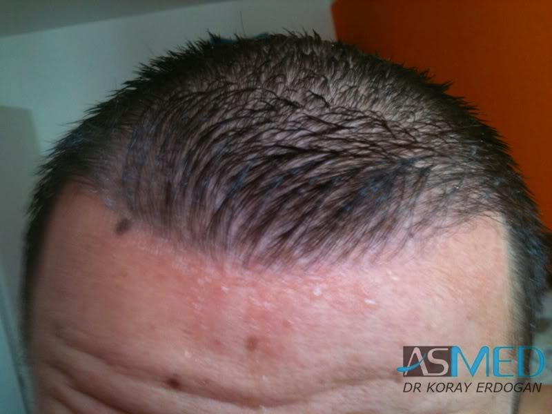 Before and After  graft    transplant at 