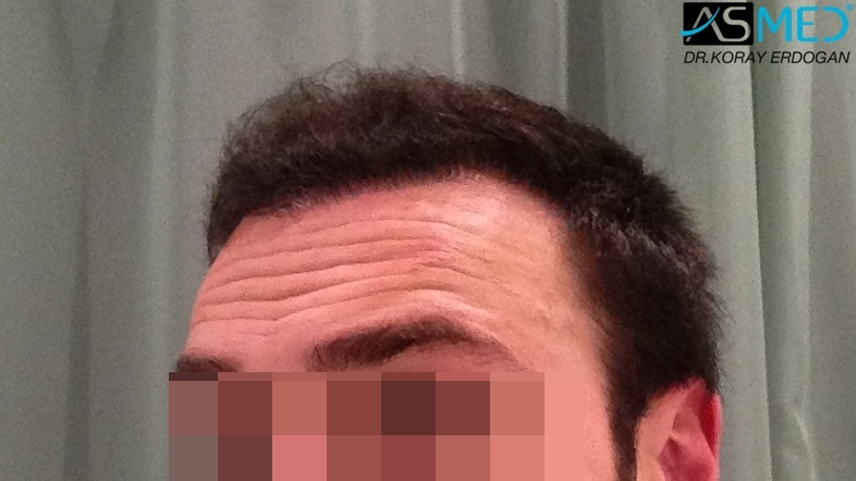 FUE Hair Transplant Result
