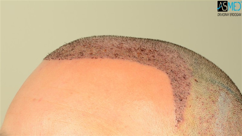 Before and After  graft    transplant at 