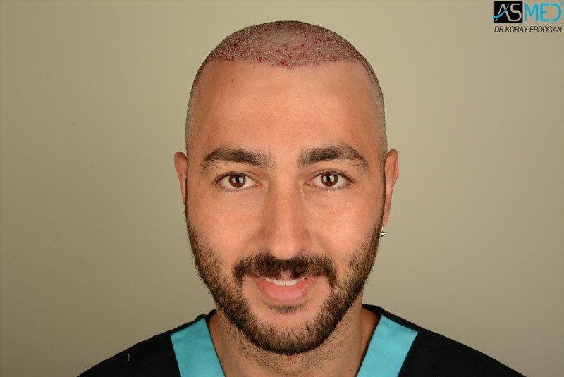Before and After  graft    transplant at 